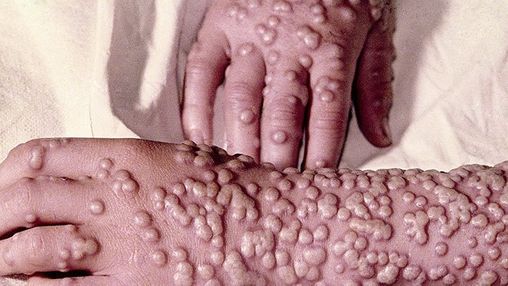 Can Smallpox Survive on Cloth: Uncovering the Truth
