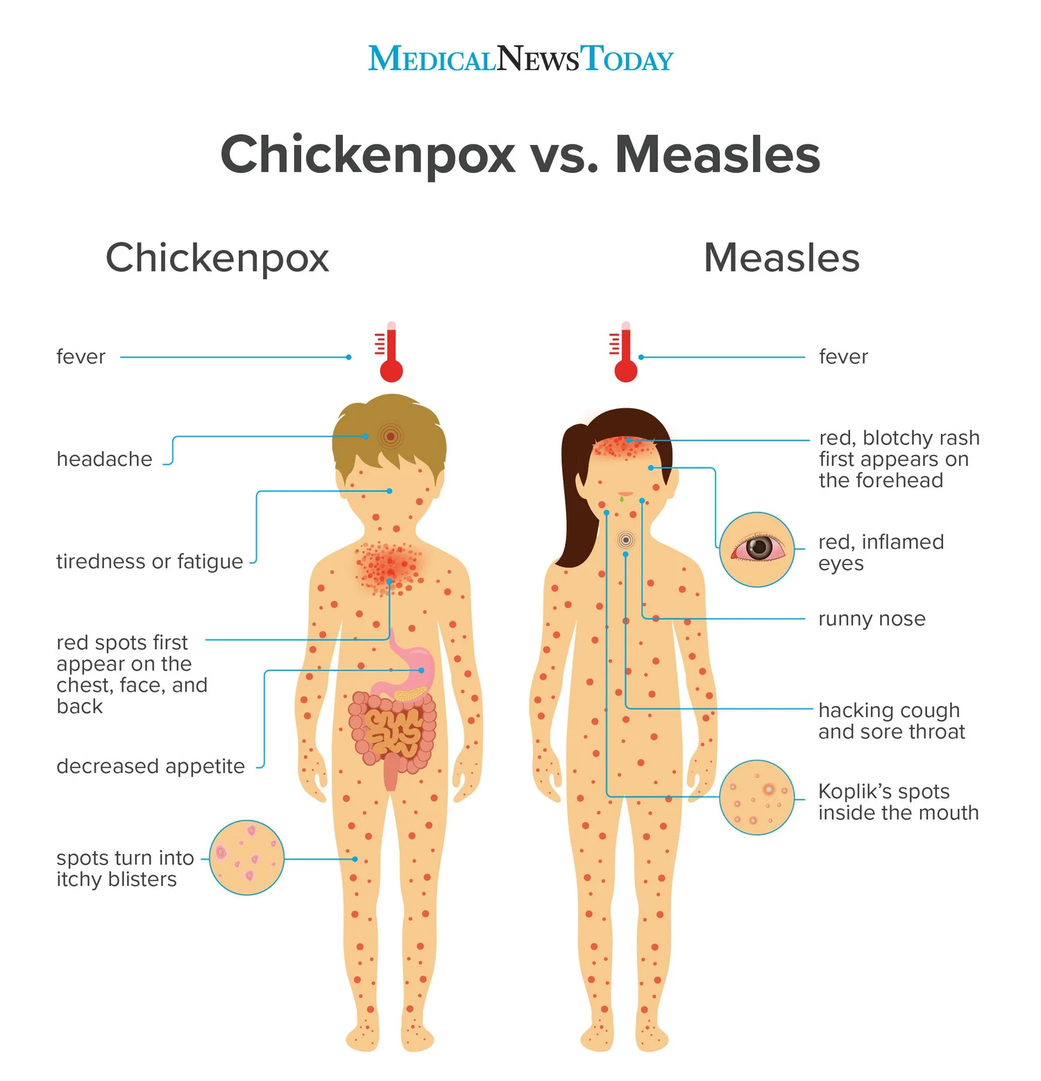 How Long Can Chicken Pox Survive on Clothes: Facts Unveiled