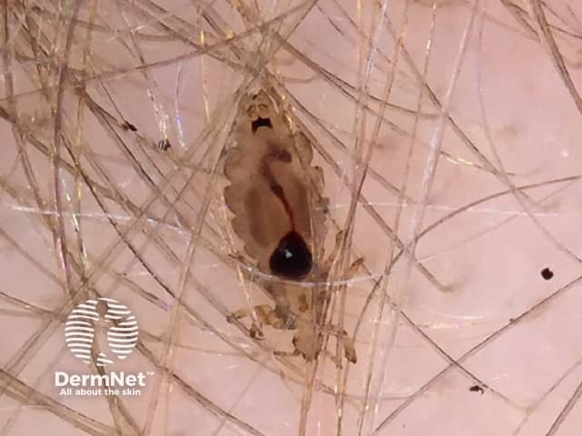 How Long Do Nits Survive on Clothes: Essential Insights